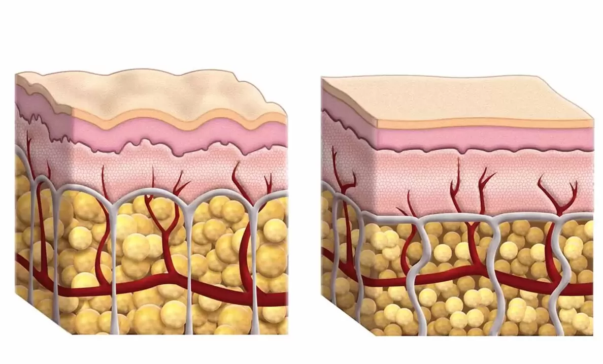 Cellules adipeuses lors de l'utilisation de Keto Guru